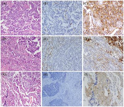 Differential Expression of PD-L1 in Central and Peripheral and TTF1-Positive and -Negative Small-Cell Lung Cancer